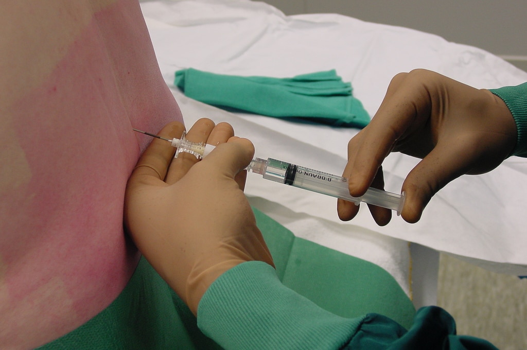 epidurale